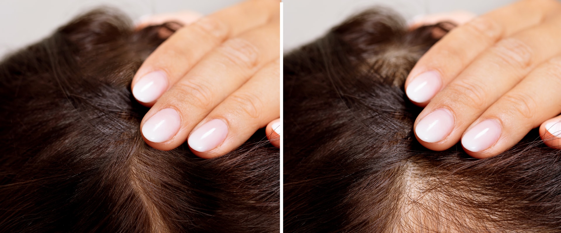 The Most Effective Solutions to Hair Loss