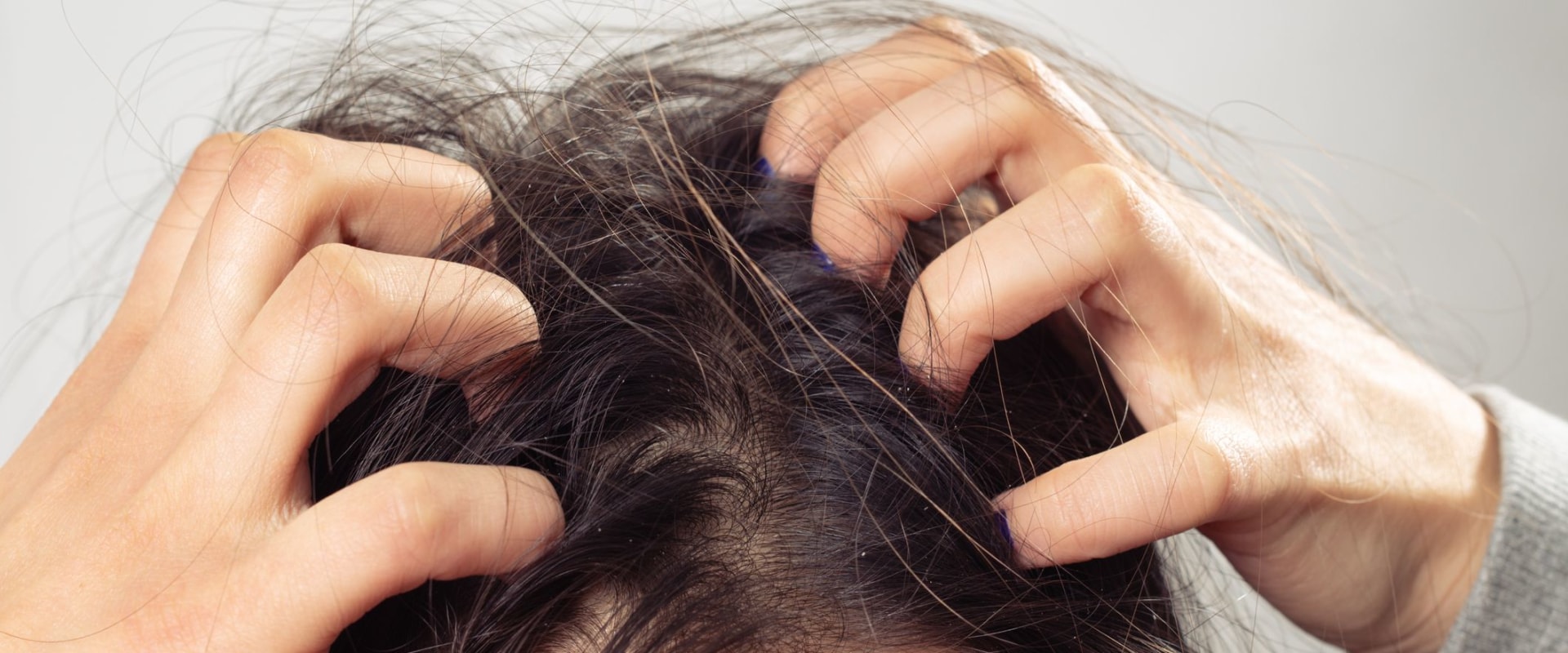 Treating Itchy Scalp and Hair Loss: Expert Tips