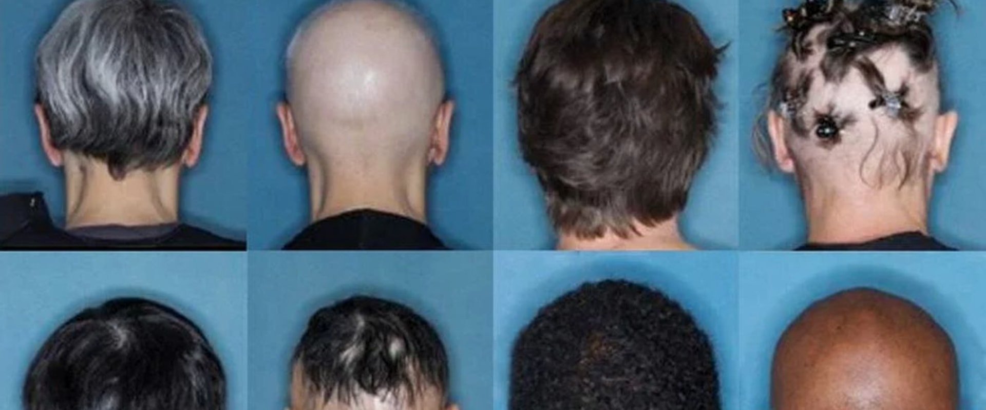 FDA Approves New Systemic Treatment for Severe Alopecia Areata