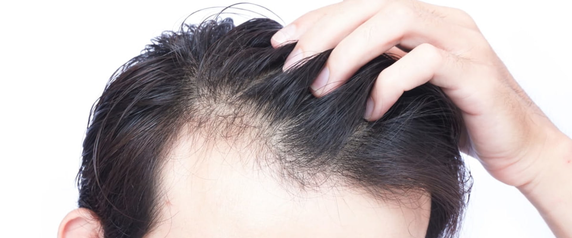 What are the Most Common Causes of Hair Loss? A Comprehensive Guide