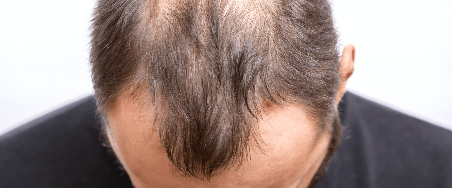 Alternative Therapies to Combat Hair Loss: Natural Solutions for Thinning Hair