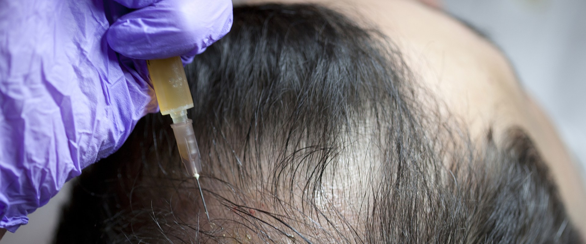 Surgical Treatments for Hair Loss: What You Need to Know