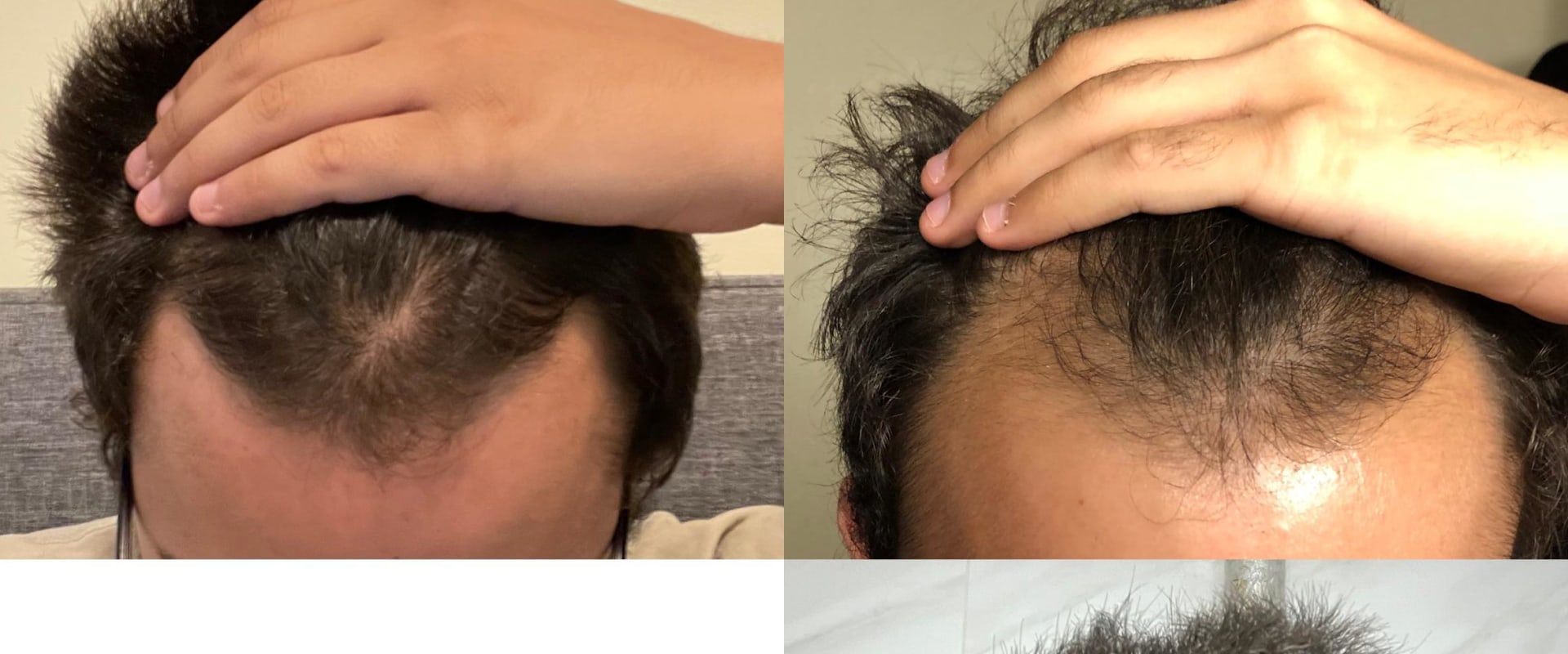 Can Hair Loss Reverse Itself? Expert Advice on How to Regrow Hair