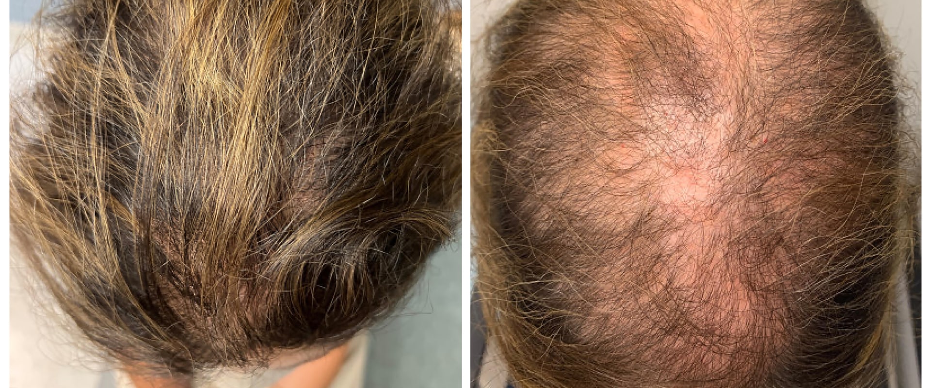 The Most Powerful Hair Loss Treatments: What You Need to Know