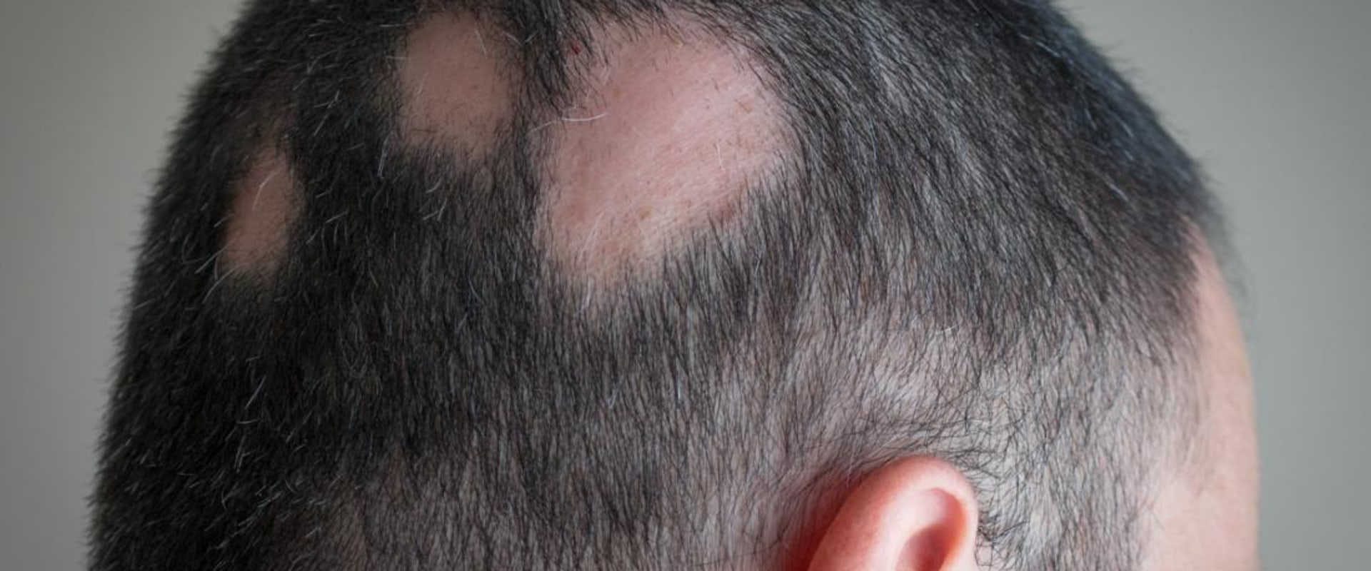 What diseases is hair loss a symptom of?