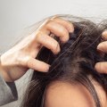 Treating Itchy Scalp and Hair Loss: Expert Tips