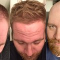 Can Hair Loss Be Reversed? - A Comprehensive Guide