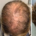 Medications to Help with Hair Loss: What You Need to Know