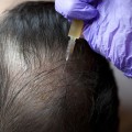 Surgical Treatments for Hair Loss: What You Need to Know