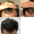 Can Hair Loss Reverse Itself? Expert Advice on How to Regrow Hair