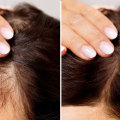 The Best Over-the-Counter Solutions for Hair Loss: A Comprehensive Guide