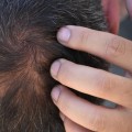 How Long Does it Take for Hormonal Hair Loss to Grow Back?