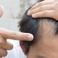 Can Hair Loss Be Stopped Naturally? - A Comprehensive Guide