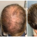 The Most Effective Hair Loss Treatments: What You Need to Know