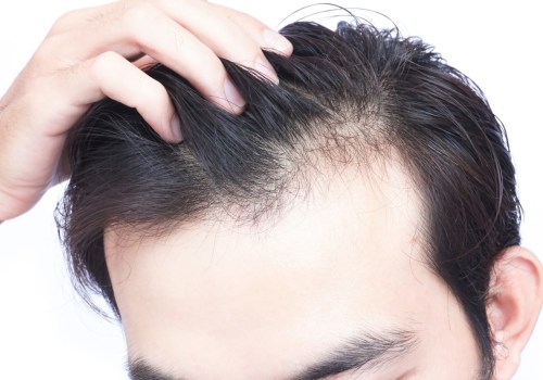 What Can I Do If My Hair is Thinning But Not Falling Out Completely?