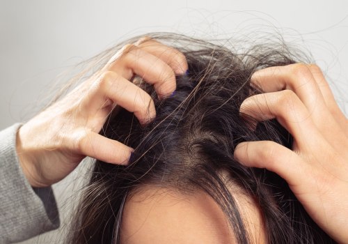 Treating Itchy Scalp and Hair Loss: Expert Tips