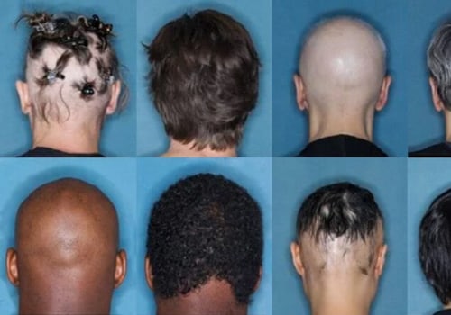 FDA Approves New Systemic Treatment for Severe Alopecia Areata