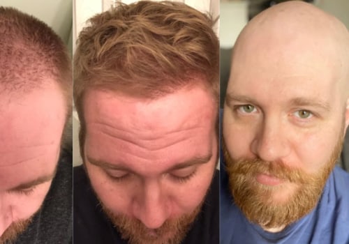 Can Hair Loss Be Reversed? - A Comprehensive Guide