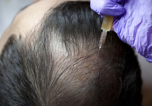 Surgical Treatments for Hair Loss: What You Need to Know