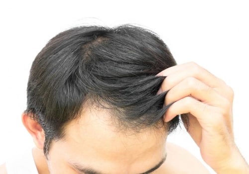 Regrow Your Lost Hair: Expert Tips and Tricks to Get Your Hair Back