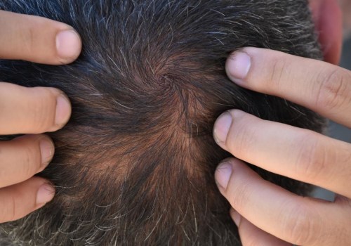 How Long Does it Take for Hormonal Hair Loss to Grow Back?