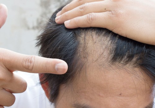 Can Hair Loss Be Stopped Naturally? - A Comprehensive Guide