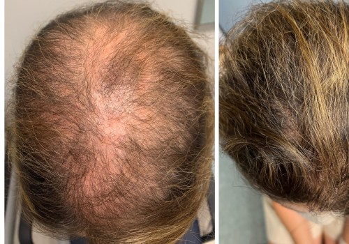 The Most Powerful Hair Loss Treatments: What You Need to Know