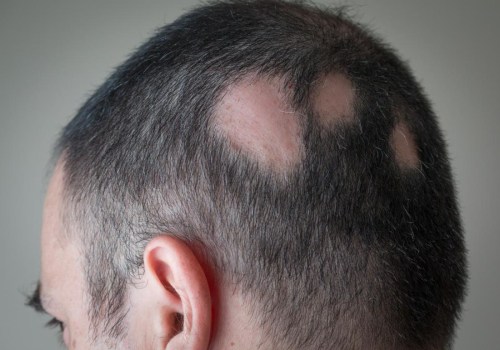 What diseases is hair loss a symptom of?